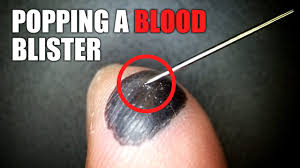 Maybe you would like to learn more about one of these? Popping A Blood Blister Under The Microscope Youtube