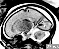 Hypoplasia of pons & cerebellum. Prenatal Us And Mr Imaging Findings Of Lissencephaly Review Of Fetal Cerebral Sulcal Development Radiographics