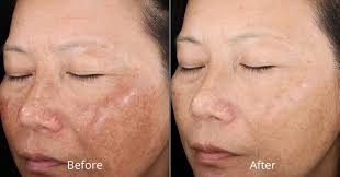 How To Do A Chemical Peel At Home Chemical Peel Chemical Peel At Home Natural Aging Skin Care