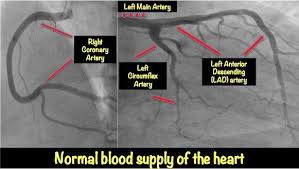 Experts agree that clogged arteries (atherosclerosis) decrease blood flow to your heart, which may cause chest pain and shortness of breath. Heart Blockage Explained With Pictures Myheart
