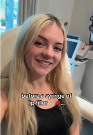 Best Lip Filler Services in Tampa at Cell Renew