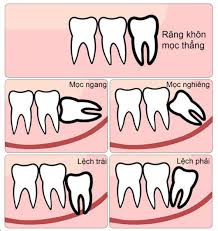 Tại sao cần nhổ răng khôn