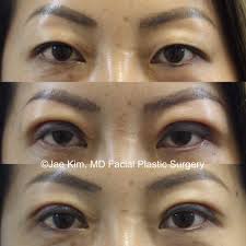 Eyebrow position changes as we age. Asian Plastic Surgery Fairfax Virginia Asian Rhinoplasty Eyelid Surgery