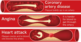 Heart attacks can be anticipated q. Angina Heart Disease Causes Symptoms Heart Foundation