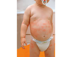 Clear fluid may come from the affected areas, which often thickens over time. Einschrankung Der Lebensqualitat Durch Neurodermitis Atopische Dermatitis Ein Update Zum Stand Von Diagnostik Therapie Und Pravention Arztcme