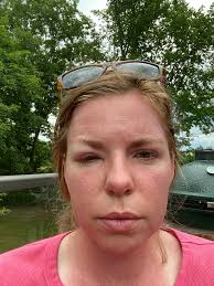 Has anyone experienced anemia after implants?