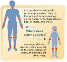 How to cure eczema fast at home. How To Treat Eczema At Home Fast Www Squidoo Com How To Cure Eczema Naturally Prlog