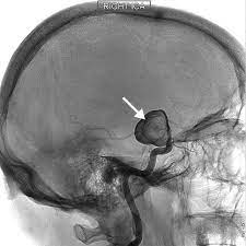 The most serious risk of a cerebral angiogram is stroke. Stroke Diagnosis And Treatment Mayo Clinic