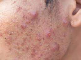 Como Quitar El Acne De Las Mejillas En Tres Pasos Paperblog