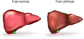Pour diagnostiquer des métastases hépatiques. Cancer Du Foie Facteurs De Risque Symptomes Diagnostic Traitements