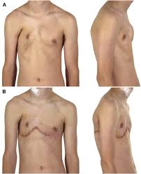 To view before and after photos of poland syndrome patients , please click on each thumbnail to enlarge to full size. Chest Wall Repair In Poland Syndrome Complex Single Stage Surgery Including Vertical Expandable Prosthetic Titanium Rib Stabilization A Case Report Journal Of Pediatric Surgery