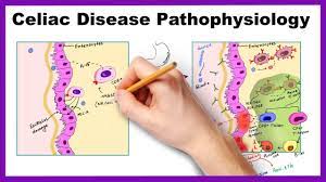 Classic symptoms include gastrointestinal problems such as chronic diarrhoea, abdominal distention, malabsorption, loss of appetite. Celiac Disease Pathophysiology Simplified Youtube