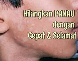 Cara menghilangkan panu selanjutnya adalah dengan menggunakan bahan alami, yakni belimbing wuluh. Cara Hilangkan Panau Dengan Cepat Dan Selamat Serimuslimah Sihat