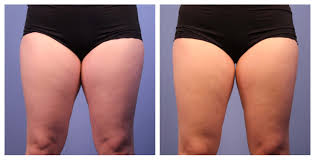 Maybe you would like to learn more about one of these? Coolsculpting Thighs Leg Sculpting Treatments Discover High Quality Coolsculpting Legs Thigh Treatments In Dallas With Element Body Lab