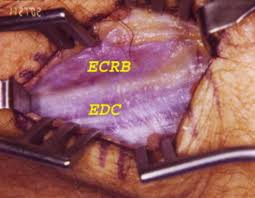 Radial Tunnel Syndrome Hand Orthobullets