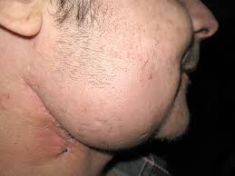 You won't lose the hair on your head. Radiation Therapy Hair Loss Mouth Cancer Radiation Therapy Flickr