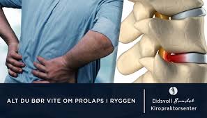 Med trygge, så refererer vi til at dette er øvelser som styrker kjerne og. Alt Du Bor Vite Om Prolaps I Ryggen Stor Guide Eidsvoll Kiropraktor
