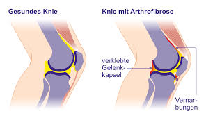 Arthrofibrose Komplikation Nach Knie Op Und Eingriffen An Anderen Gelenken Gelenk Klinik De