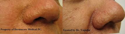 If it is bothering a person, it can be treated with physical methods such as cryotherapy, light cautery, fine wire diathermy, laser what is the likely outcome of this condition? Sebaceous Hyperplasia Removal With Radiofrequency Surgery In New York