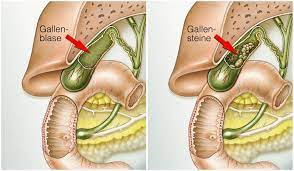Gallensteine Ursachen Symptome Therapie