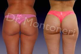 Quy nhon · 6 years ago. Implants Fessiers Chirurgie Pour Remodeler Et Augmenter Les Fesses