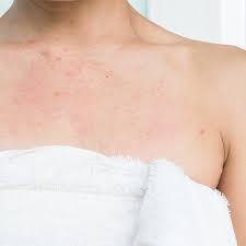 Image result for Atopic eczema atopic dermatitis
