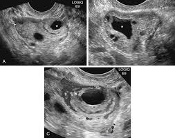 Image result for corpus luteum sonography)