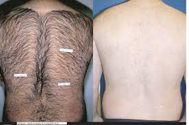 Laser hair removal uses light to target the pigment in individual hairs. Laser Hair Removal