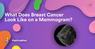 The type of tissue where your breast cancer arises determines how the cancer behaves and what treatments are most effective. What Does Breast Cancer Look Like On A Mammogram Positivemed