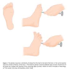 Image result for Babinski Reflex