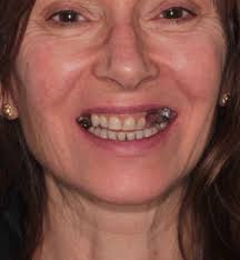 Case Study #2: Successful Dental Implant at Surbiton Dental