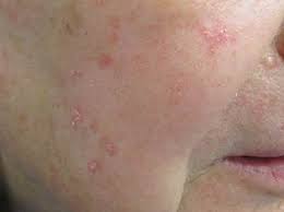 When wondering what skin cancer looks like on your face it is important to know that melanoma can occur in a variety of colors including brown, black, red, blue … Skin Cancer Toronto Dermatology Centre