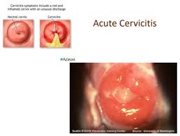 Image result for Acute Cervicitis