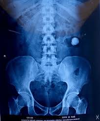 Image result for Nephrolithiasis Imaging