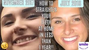 How to Straighten Your Teeth at Home in Less Than 1 Year!!