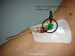 что будет если через капельницу в вену попадет воздух Rabota S Perifericheskim Kateterom Forum Medicinskih Sestyor