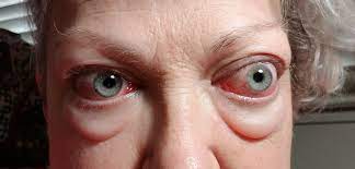 Pin On Graves Thyroid Eye Disease