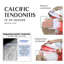 Image result for Rotator Cuff Calcification