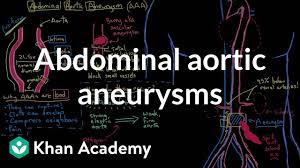 Abdominal Aortic Aneurysms Video Khan Academy