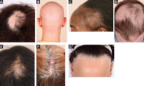 Over 21 million women and 35 million men in america suffer from hair loss. Male And Female Pattern Hair Loss A Guide To Clinical Presentations And Diagnosis Consult Qd