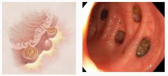 La diverticolosi del colon tecnicamente è un'anomalia congenita o acquisita: Diverticoli Del Colon Prof Giorgio Battaglia