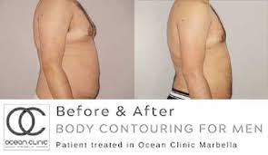 Jul 10, 2012 · if you want to get rid of it, then the first and foremost option is to lose weight around the groin which would involve following some instructions specific to your problem. Liposuction For Men 10 Facts Oc Latest News