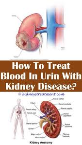 Pin On Kidney Disease