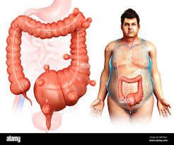 Image result for Megacolon