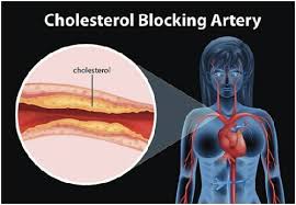 Cholesterol Symptoms Causes And Treatment