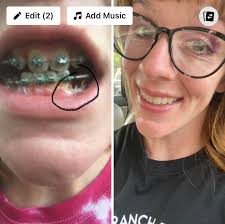 Adult with retained baby teeth gets orthodontic treatment