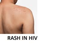 Image result for skin rash acute hiv infection