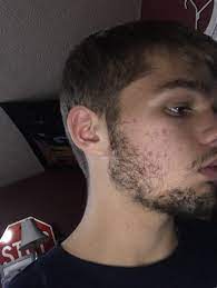 For example, a 2015 study involving women with thinning hair were given an oral marine protein supplement (mps) containing biotin or a placebo pill twice per. 17 Years Old Been Growing For Under A Month Already Taking Biotin And Using Beard Oil Considering Minoxidil Any Tips On How Minoxidil Beard Minoxidil Beard