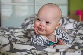 Children with down syndrome have multiple malformations, medical conditions, and cognitive impairment because of the presence of extra genetic material from chromosome 21. Down Syndrom Fratz Co Das Osterreichische Familienmagazin