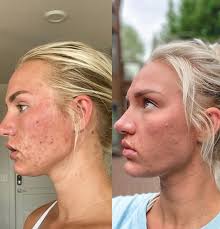 These calculations involve both dosage level, the degree of the skin breakout, and the time. My Experience On Accutane Mikzazon Com